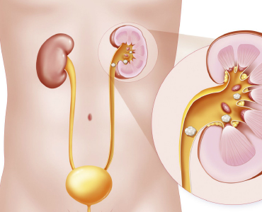 Kidney Stone Do and Dont
