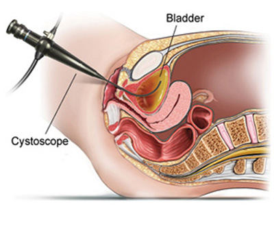 Bladder Cancer
