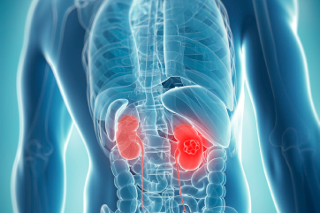 Renal Cancer